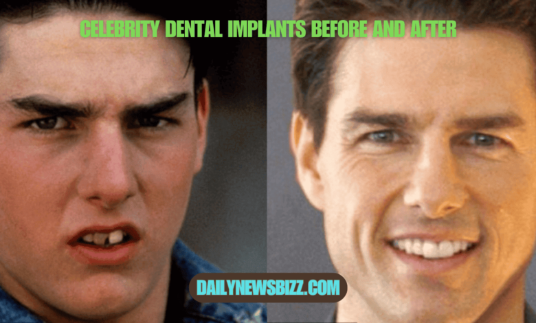 celebrity dental implants before and after
